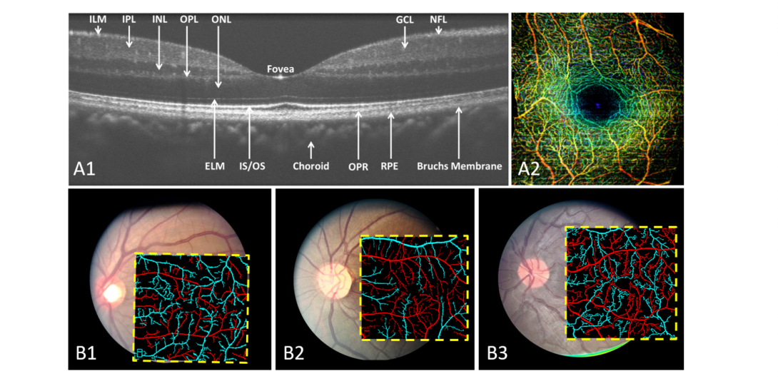 Using quantitative OCTA we can diagnosis retinal diseases