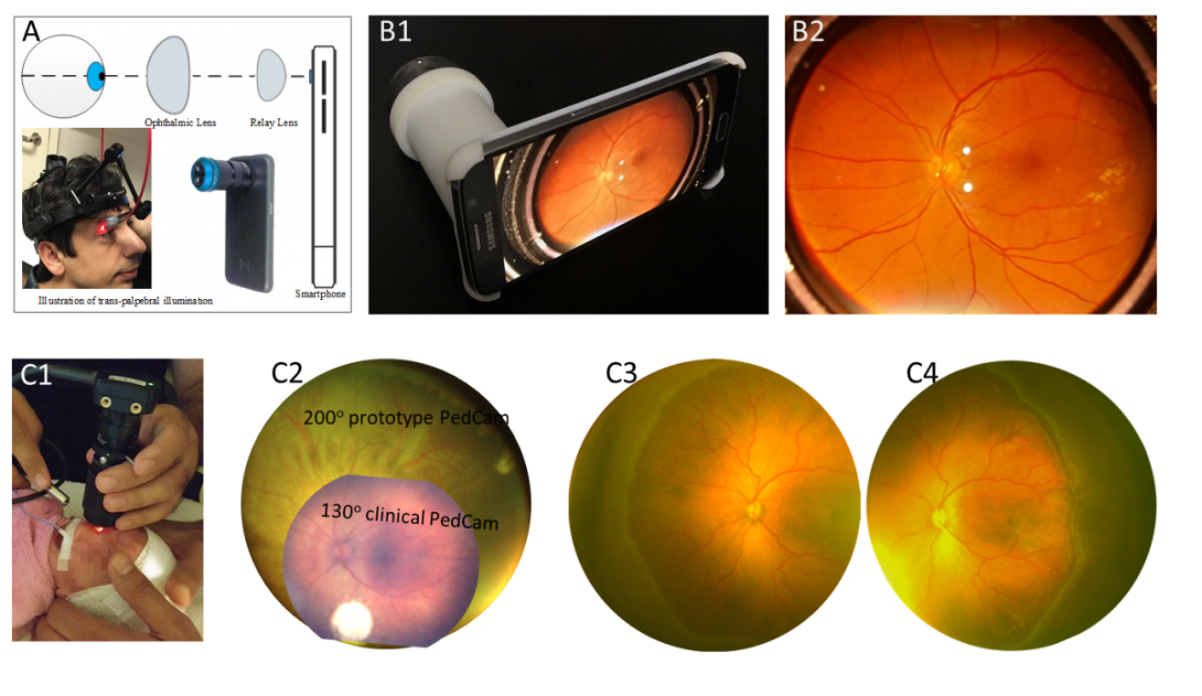 Our lab developed a wide-field fundus camera for trans-palpebral illumination