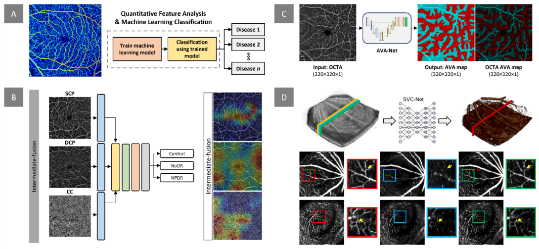 OCTA analysis and AI classification