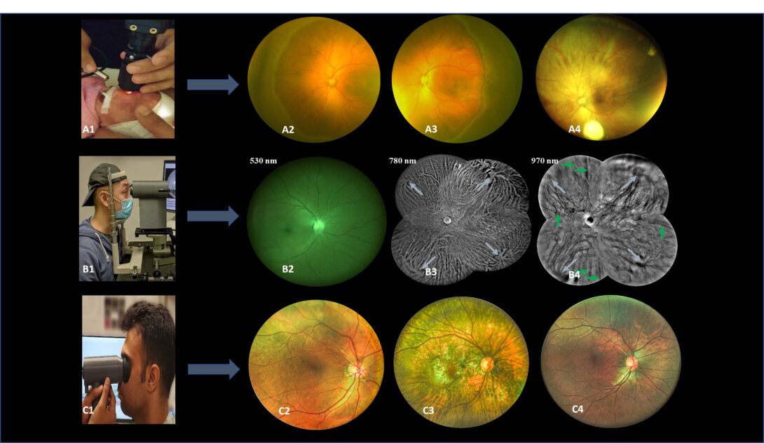 Our lab developed a wide-field fundus camera for trans-palpebral illumination